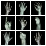 Collection X-ray Of Hands Stock Photo