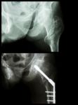 Intertrochanteric Fracture Left Femur (fracture Thigh's Bone). It Was Operated And Insert Intramedullary Nail Stock Photo