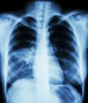 Pneumonia ( Film Chest X-ray Show Alveolar Infiltrate At Right Middle Lung ) ( Image For Pulmonary Tuberculosis , Mers-cov , Sars ) Stock Photo