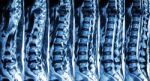 Mri Of Lumbar & Thoracic Spine : Show Fracture Of Thoracic Spine And Compress Spinal Cord ( Myelopathy ) Stock Photo