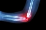 Rheumatoid Arthritis , Gouty Arthritis ( Film X-ray Child 's Elbow With Arthritis At Elbow ) ( Side View , Lateral ) Stock Photo