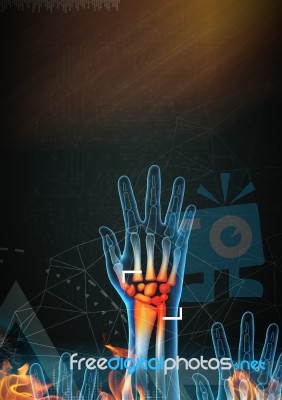 3d Rendered Anatomy Illustration - Hand Pain Stock Image