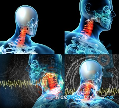 3d Rendered Illustration - Painful Neck Stock Image