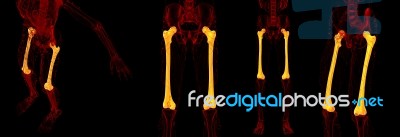 3d Rendering Medical Illustration Of The Femur Bone Stock Image