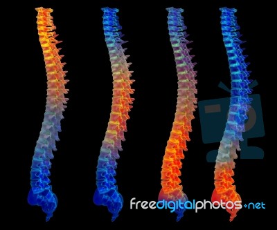 3d Rendering Painful Spine Stock Image