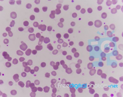 Abnormal Red Blood Cells Stock Photo