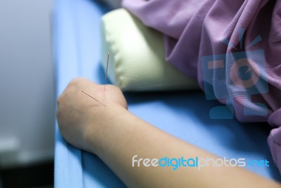 Acupuncture Stock Photo