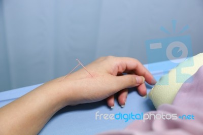 Acupuncture Stock Photo