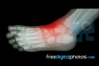 Arthritis And Injury At Ankle  :  Film X-ray Of Child 's Foot ( Side View ) ( Lateral ) Stock Photo