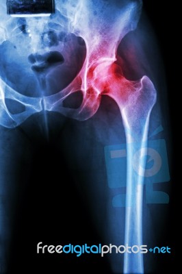 Arthritis At Hip Joint ( X-ray Pelvis & Hip Joint ) , ( Gout , Rheumatoid ) Stock Photo