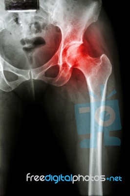 Arthritis At Hip Joint ( X-ray Pelvis & Hip Joint ) , ( Gout , Rheumatoid ) Stock Photo