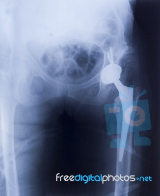 Artificial Hip Implant Stock Photo