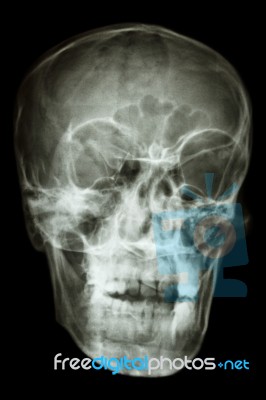 Asian People's Skull (thai People) Stock Photo