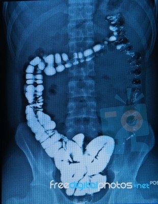 Barium Enema Abdomen Of Human Stock Photo