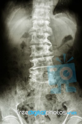 Bent Lumbar Spine And Spurs Of Old People Stock Photo