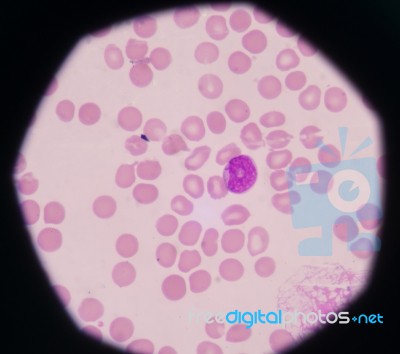 Blast Cells In Peripheral Blood Images Stock Photo