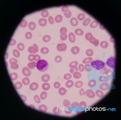Blast Cells In Peripheral Blood Images Stock Photo