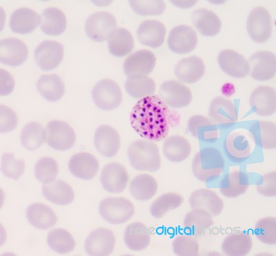 Blood Films For Malaria Parasite Stock Photo