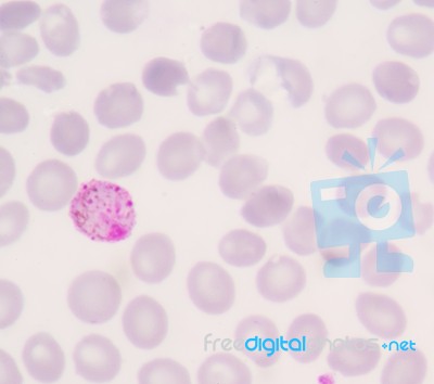 Blood Films For Malaria Parasite Stock Photo