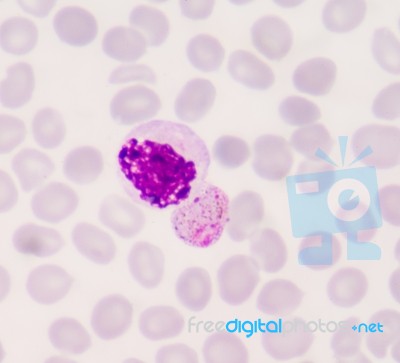 Blood Films For Malaria Parasite Stock Photo