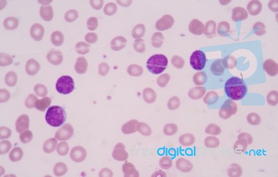 Bone Marrow: Myeloblasts With Auer Rods Seen In Acute Myeloid Le… Stock Photo