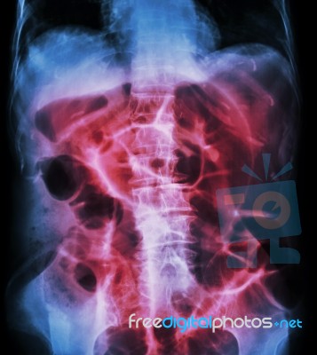 Bowel Obstruction ( X-ray Abdomen Supine Position : Large Bowel Stock Photo