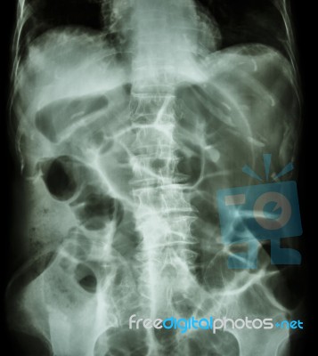 Bowel Obstruction ( X-ray Abdomen Supine Position : Large Bowel Stock Photo