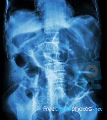 Bowel Obstruction ( X-ray Abdomen Supine Position : Large Bowel Stock Photo