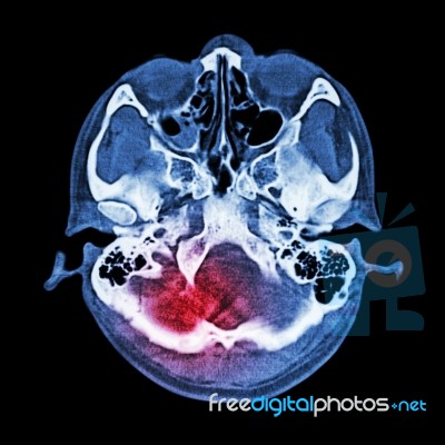 Brain Injury, Stroke : ( Ct Scan Of Brain And Base Of Skull ) ( Bone Window ) Stock Photo