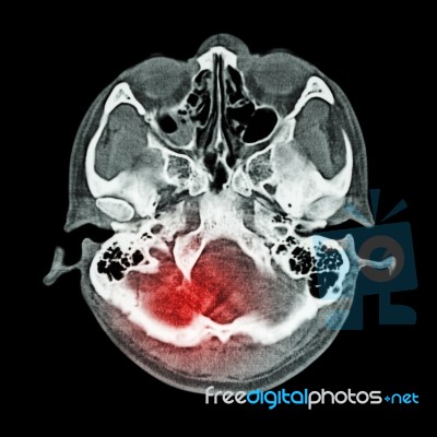 Brain Injury, Stroke : ( Ct Scan Of Brain And Base Of Skull ) ( Bone Window ) Stock Photo