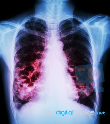 Bronchiectasis Stock Photo