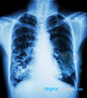 Bronchiectasis Stock Photo