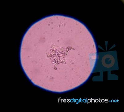 Calcium Oxalate Crystal In Urine Analysis Stock Photo