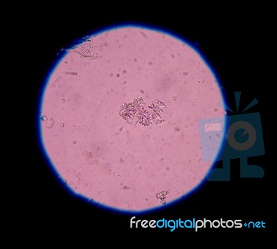 Calcium Oxalate Crystal In Urine Analysis Stock Photo