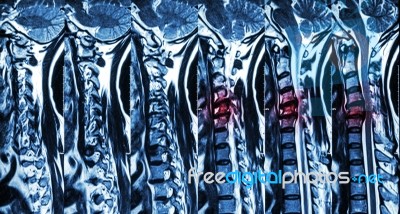 Cervical Spondylosis With Disc Herniation ( Mri Of Cervical Spine : Show Cervical Spondylosis With Disc Herniation Compress Spinal Cord ( Myelopathy ) ) Stock Photo