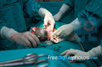 Cesarean Section Stock Photo