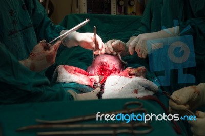 Cesarean Section Stock Photo