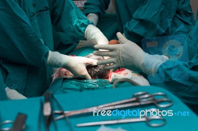 Cesarean Section Stock Photo