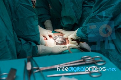 Cesarean Section Stock Photo