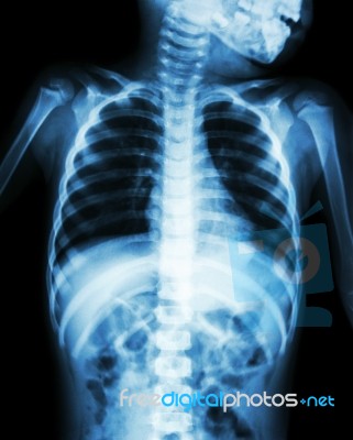 Chest X-ray Of Child Show Neck , Thorax , Shoulder , Arm , Abdomen Stock Photo