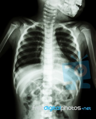 Chest X-ray Of Child Show Neck , Thorax , Shoulder , Arm , Abdomen Stock Photo