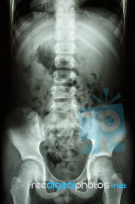 Child's Spine ,abdomen ,pelvis ,hip Stock Photo