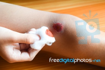 Cleaning Laceration Wound Stock Photo