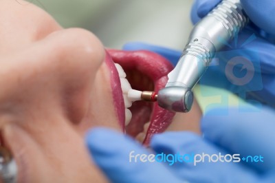 Close-up Medical Dentist Procedure Of Teeth Polish Stock Photo