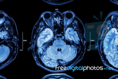 Close Up Of Mri Brain : Lower Part Of Brain ( Eyes , Temporal Lo… Stock Photo