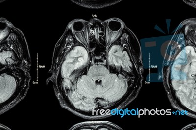 Close Up Of Mri Brain : Lower Part Of Brain ( Eyes , Temporal Lo… Stock Photo