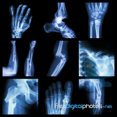 Collection Of Bone Fracture Stock Photo