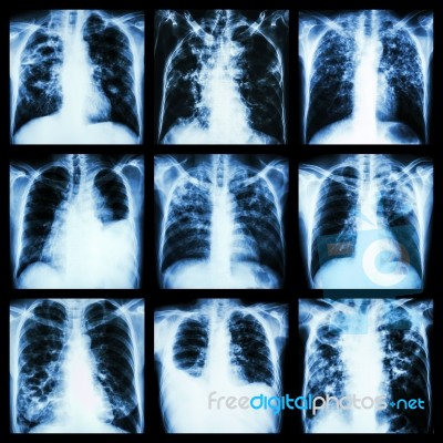 Collection Of Lung Disease (pulmonary Tuberculosis,pleural Effusion,bronchiectasis) Stock Photo