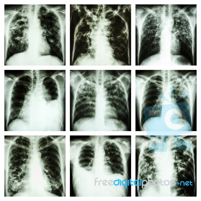 Collection Of Lung Disease (pulmonary Tuberculosis,pleural Effusion,bronchiectasis) Stock Photo