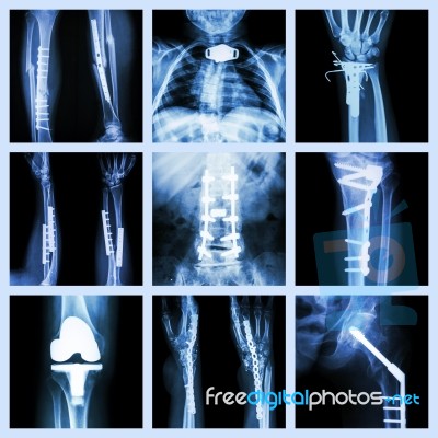 Collection Of Orthopedic Operation Stock Photo